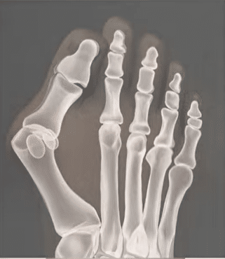 Modern bütyök műtétek (hallux valgus) 2026-ban, ami megváltoztatja az életminőségedet 2 butyok mutet elott