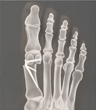 Modern bütyök műtétek (hallux valgus) 2026-ban, ami megváltoztatja az életminőségedet 3 butyok mutet utan